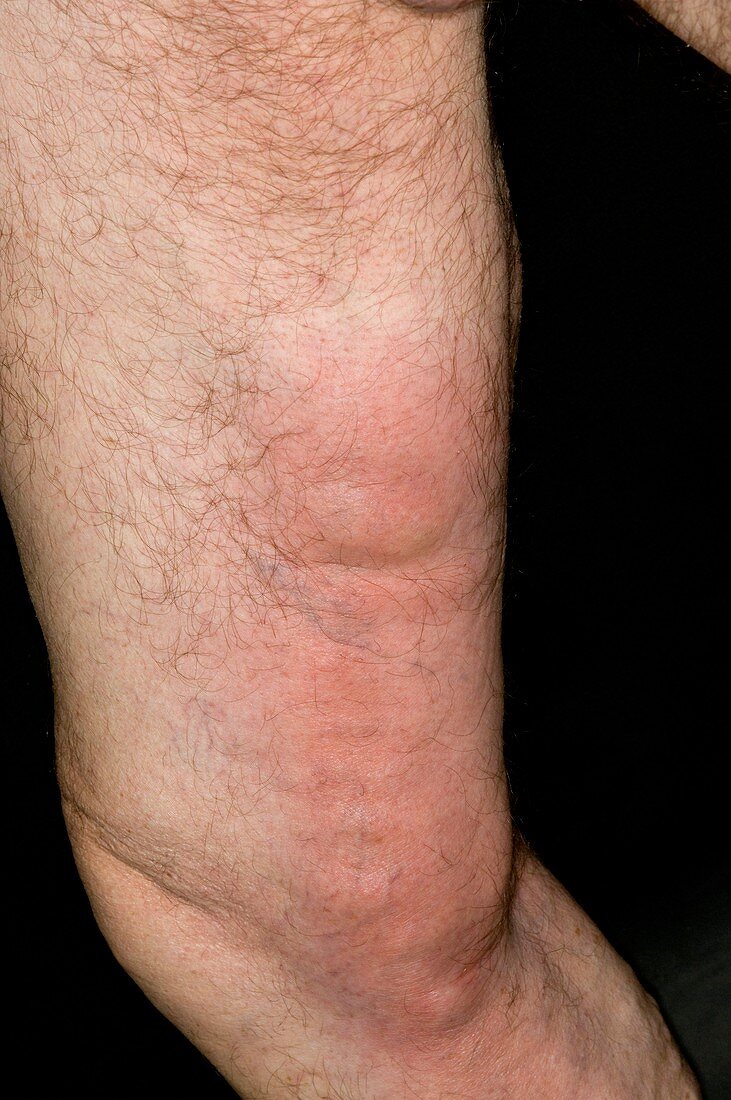 Thrombophlebitis in the thigh