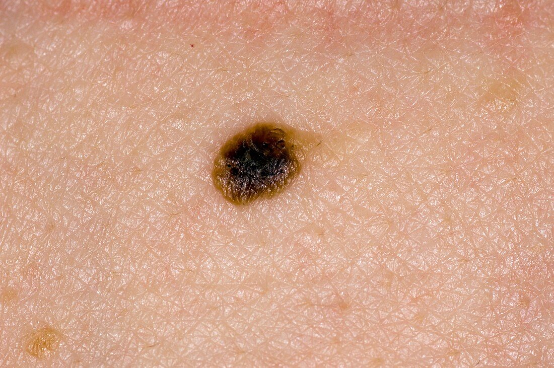 Seborrheic wart on the skin