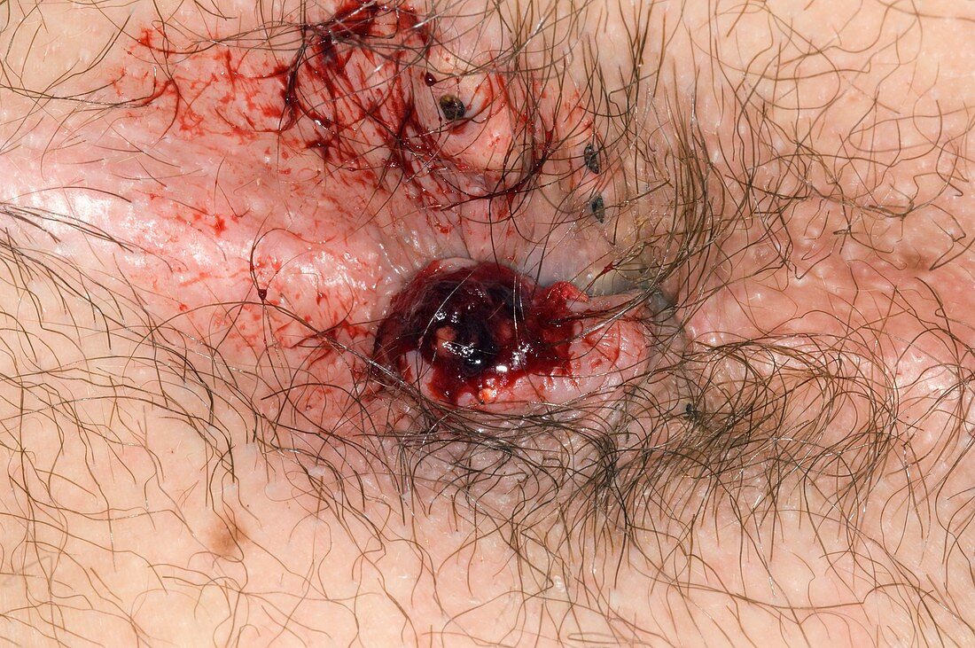 Rupture of a thrombosed pile