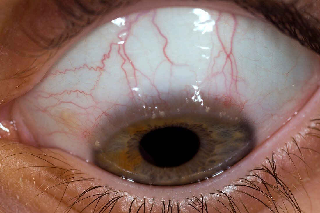 Allergic conjunctivitis of the eye