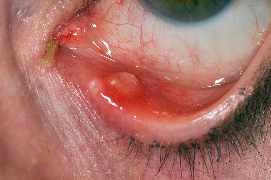 Chalazion on the lower eyelid
