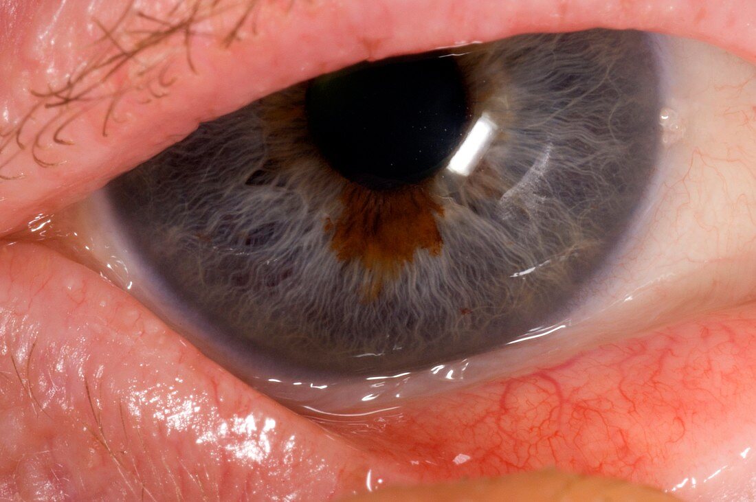 Benign naevus in the iris of the eye