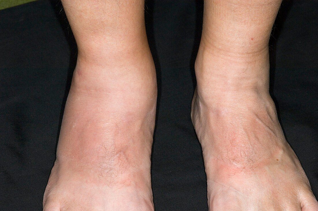 Psoriatic arthritis of the ankle