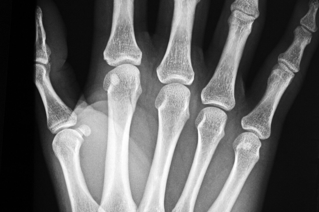 Spiral fracture of the hand,X-ray