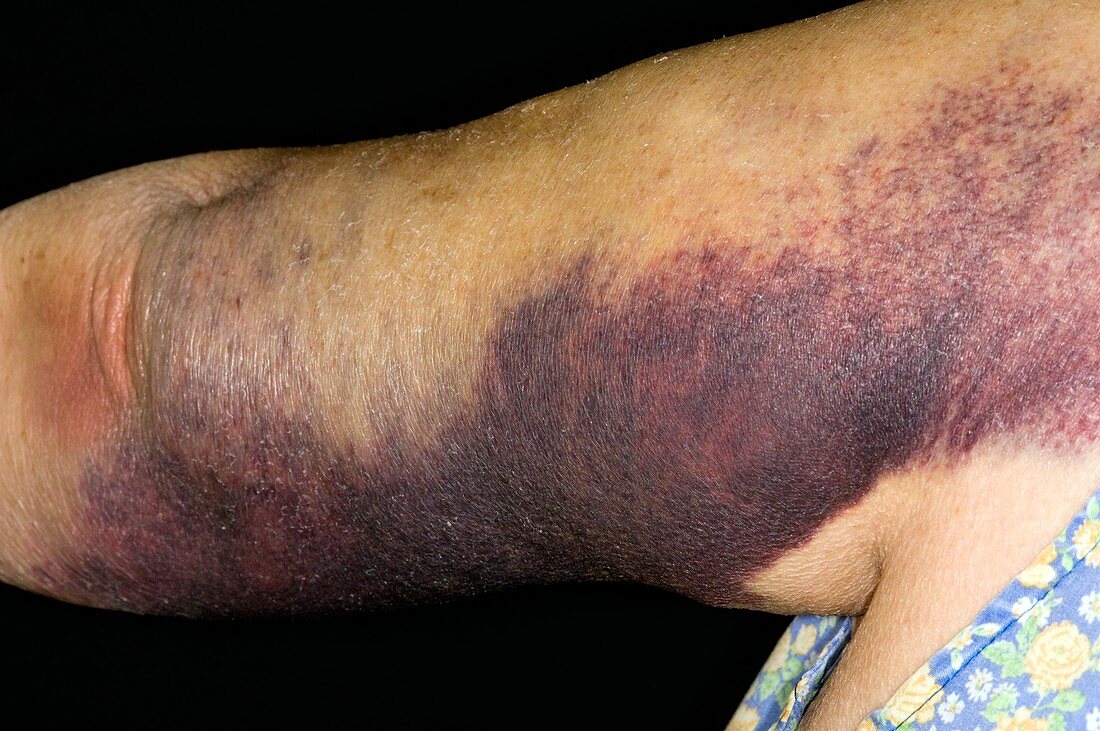 Bruised arm due to warfarin