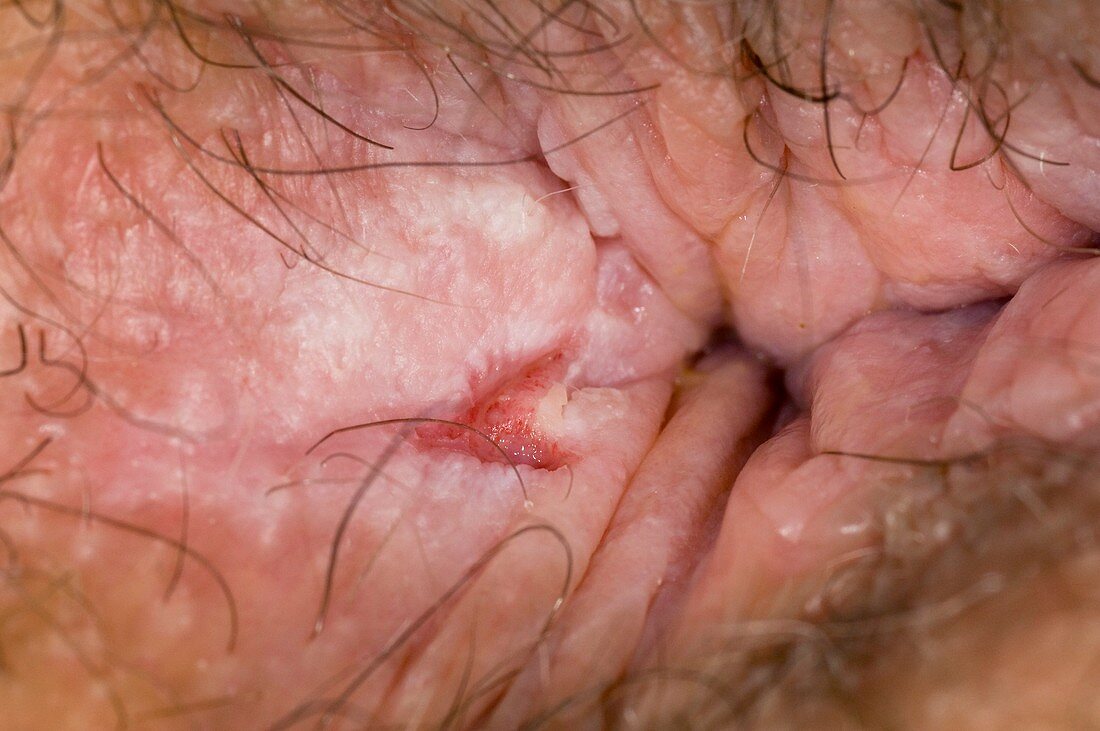 Healing anal fissure