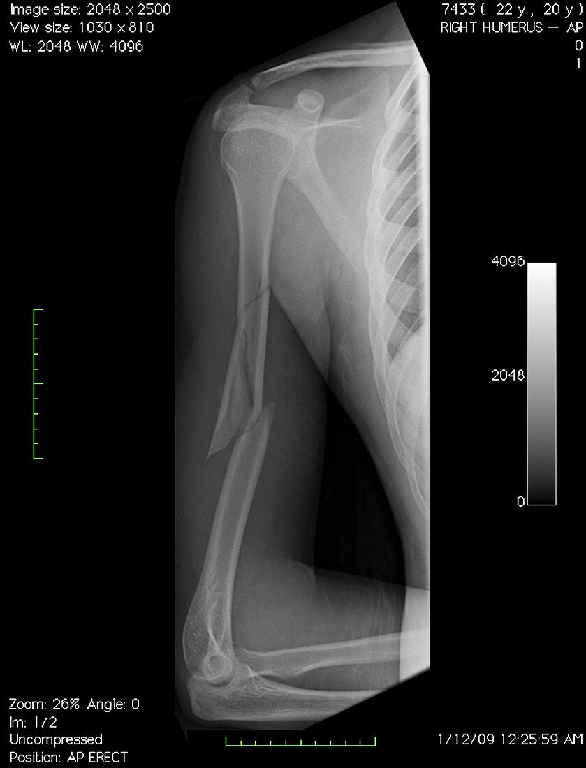 Broken arm bone,digital X-ray