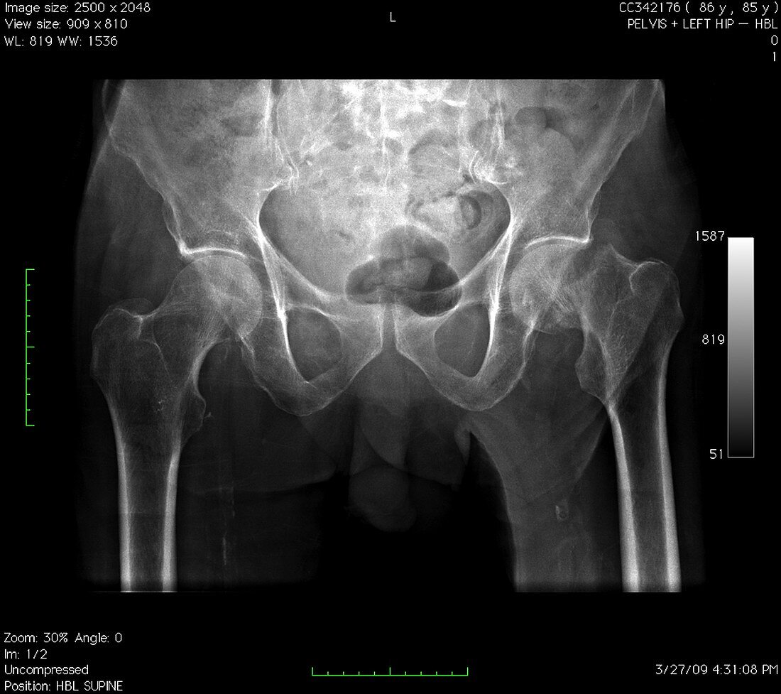 Hip fracture,digital X-ray