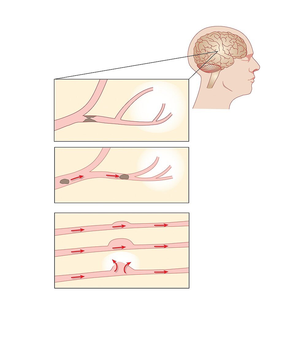 Stroke causes,artwork