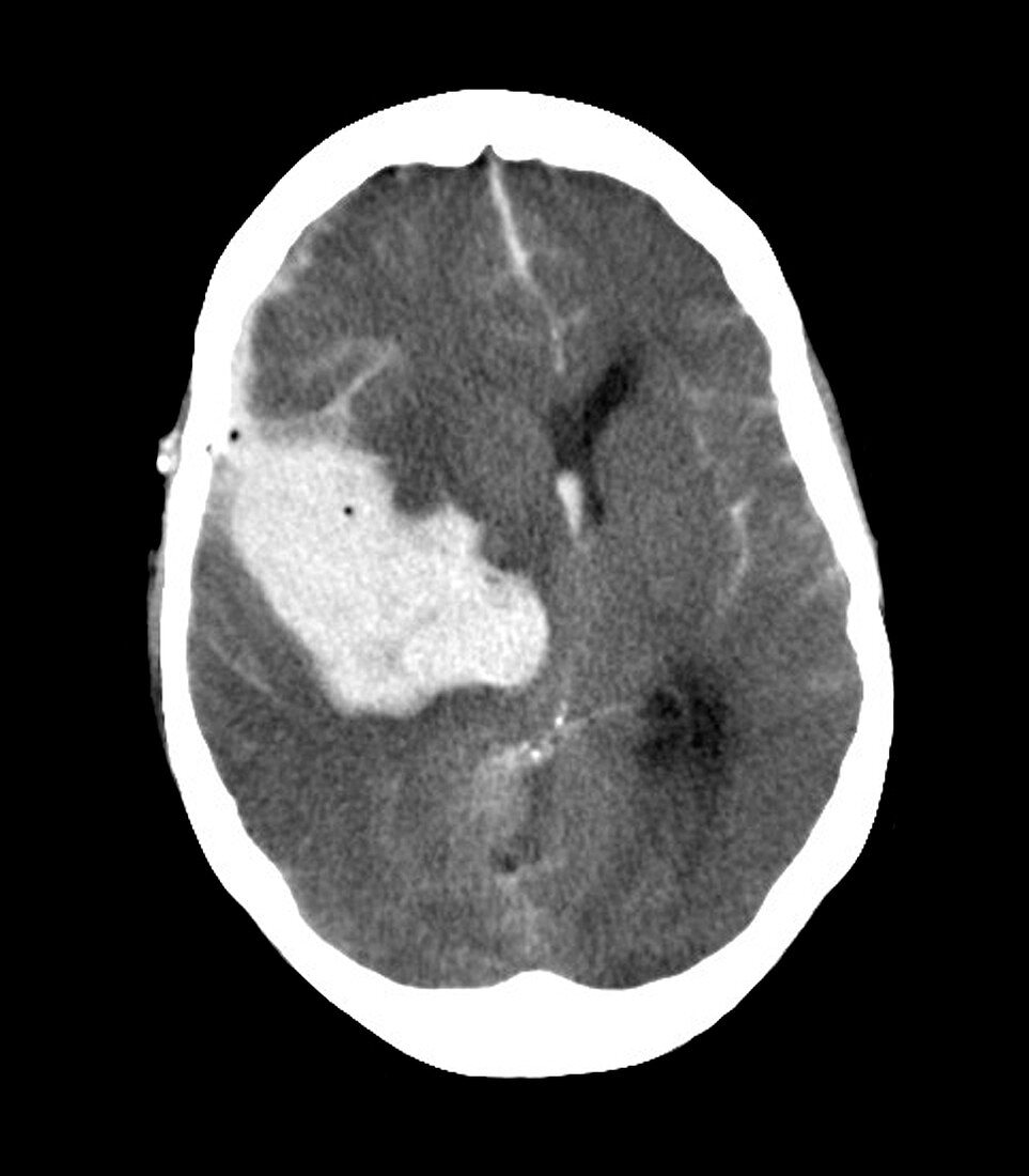Subarachnoid haemorrhage,MRI scan