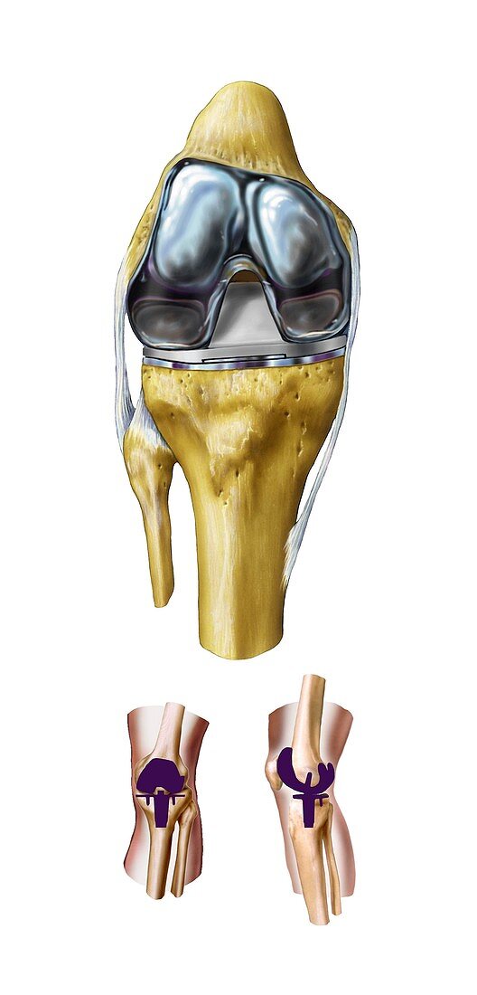 Knee replacement,artwork