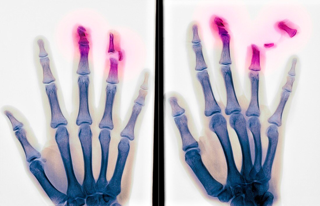 Fingertip laceration injuries,X-rays