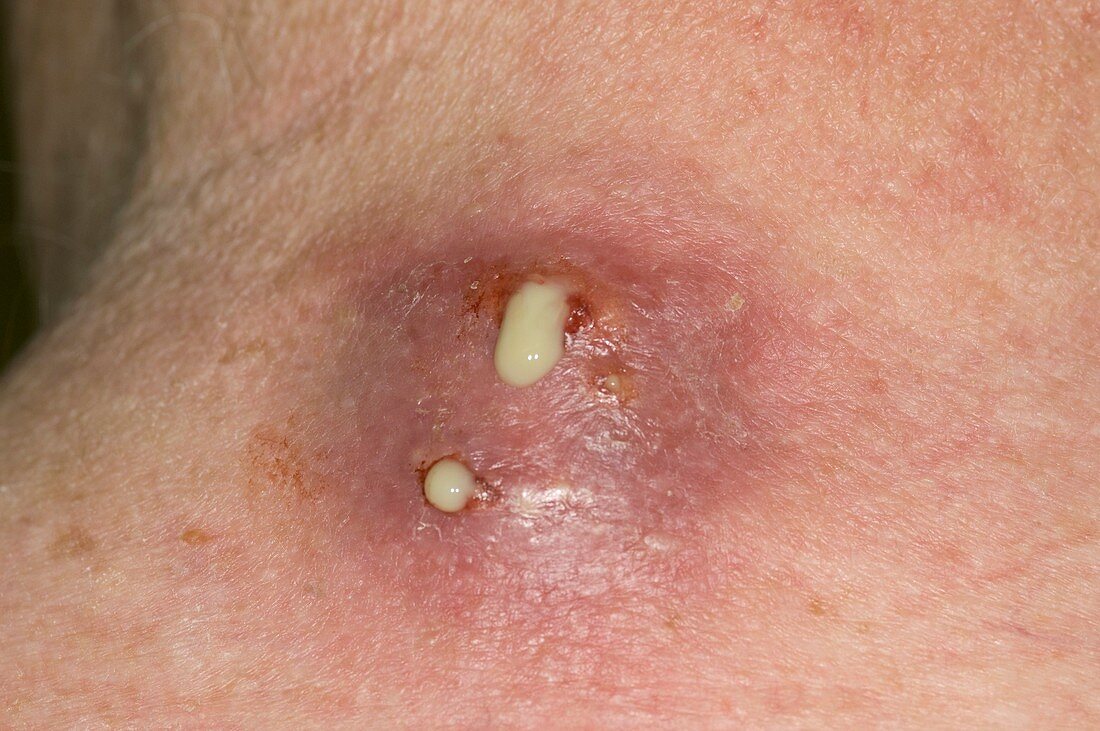 Pus oozing from abscess on neck