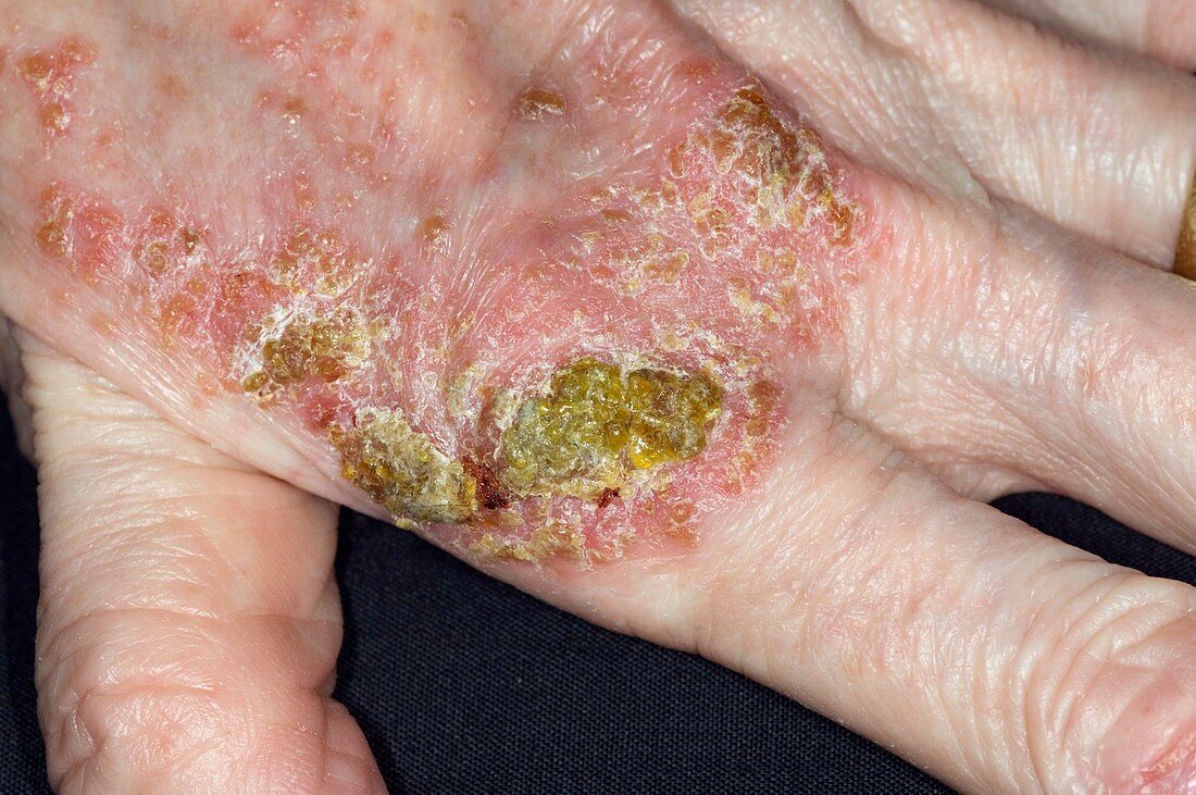 Infected eczema on the hand
