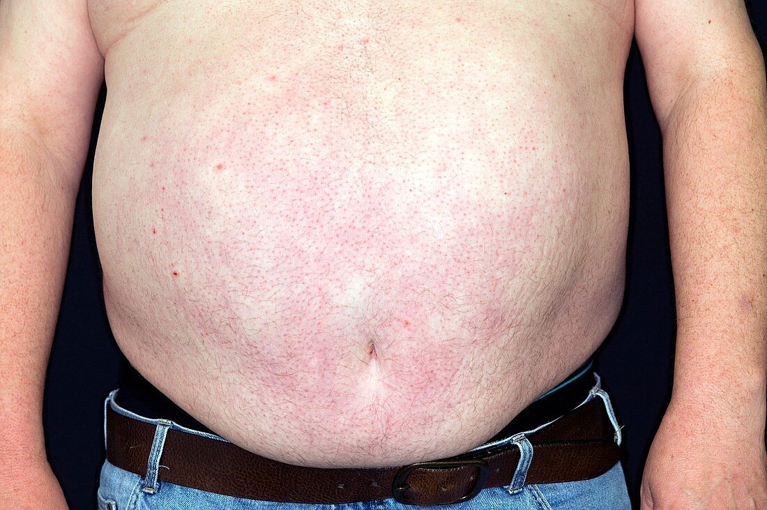 Obese abdomen in diabetes