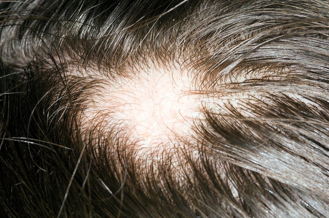 Bald patch in eczema