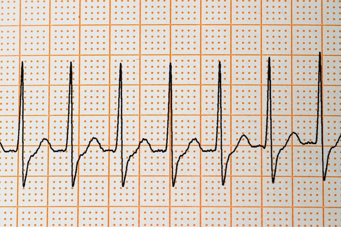 Junctional rhythm of the heartbeat