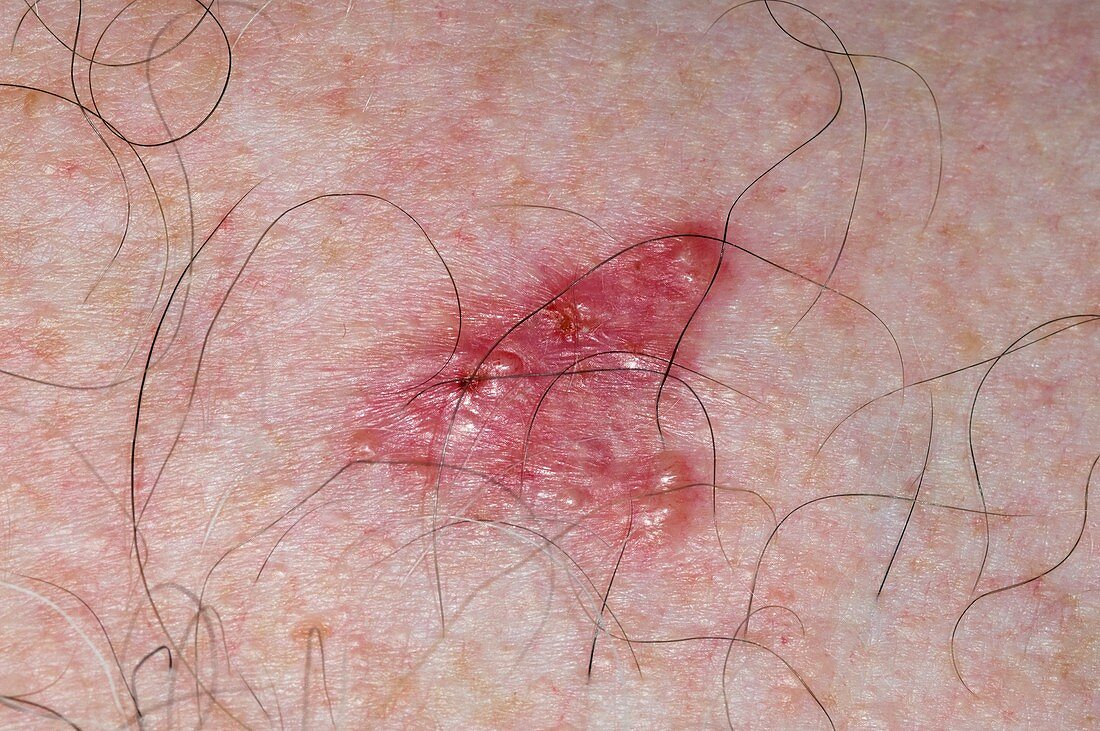 Skin cancer on the chest