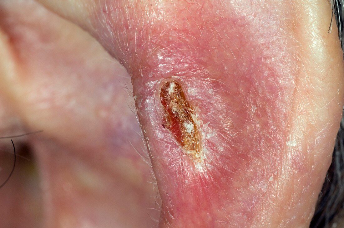 Skin cancer on the ear
