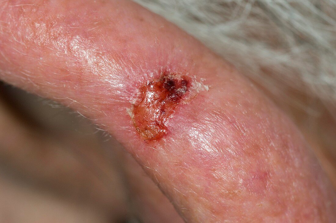 Skin cancer on the ear