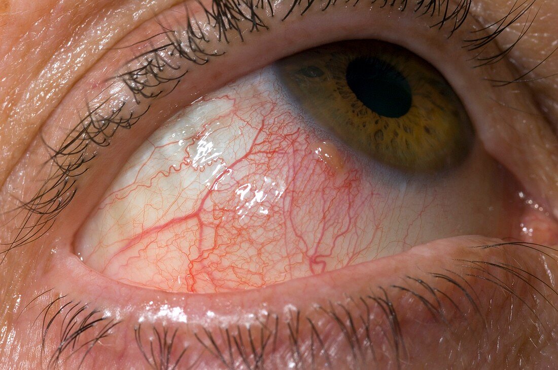 Episcleritis of the eye