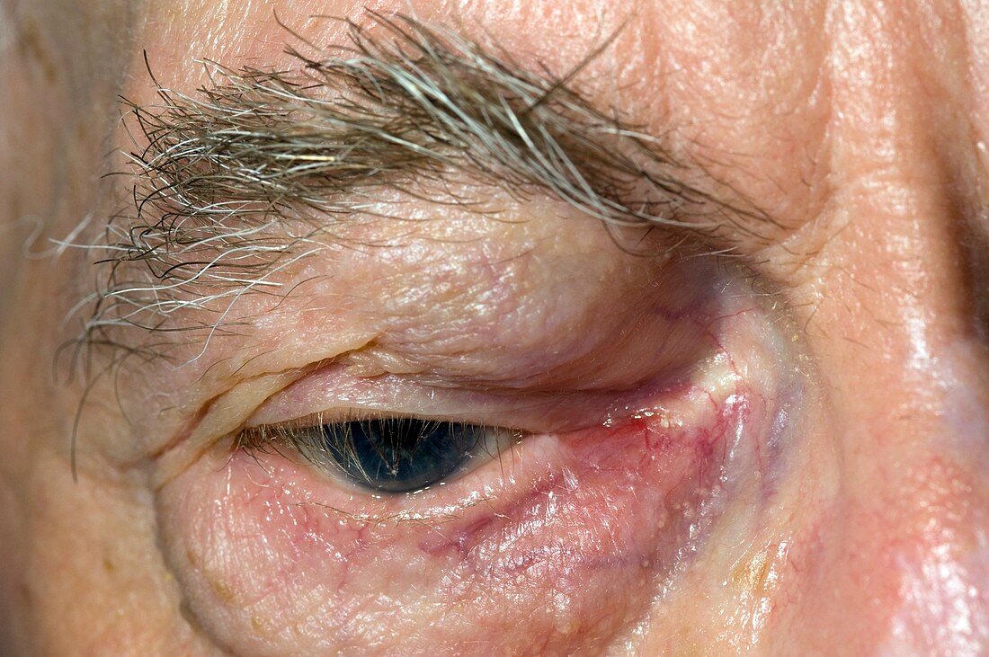 Blocked tear duct with eyelid swelling