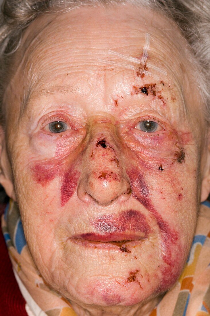 Bruised face following a fall