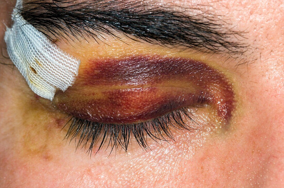 Black eye from a sport's injury