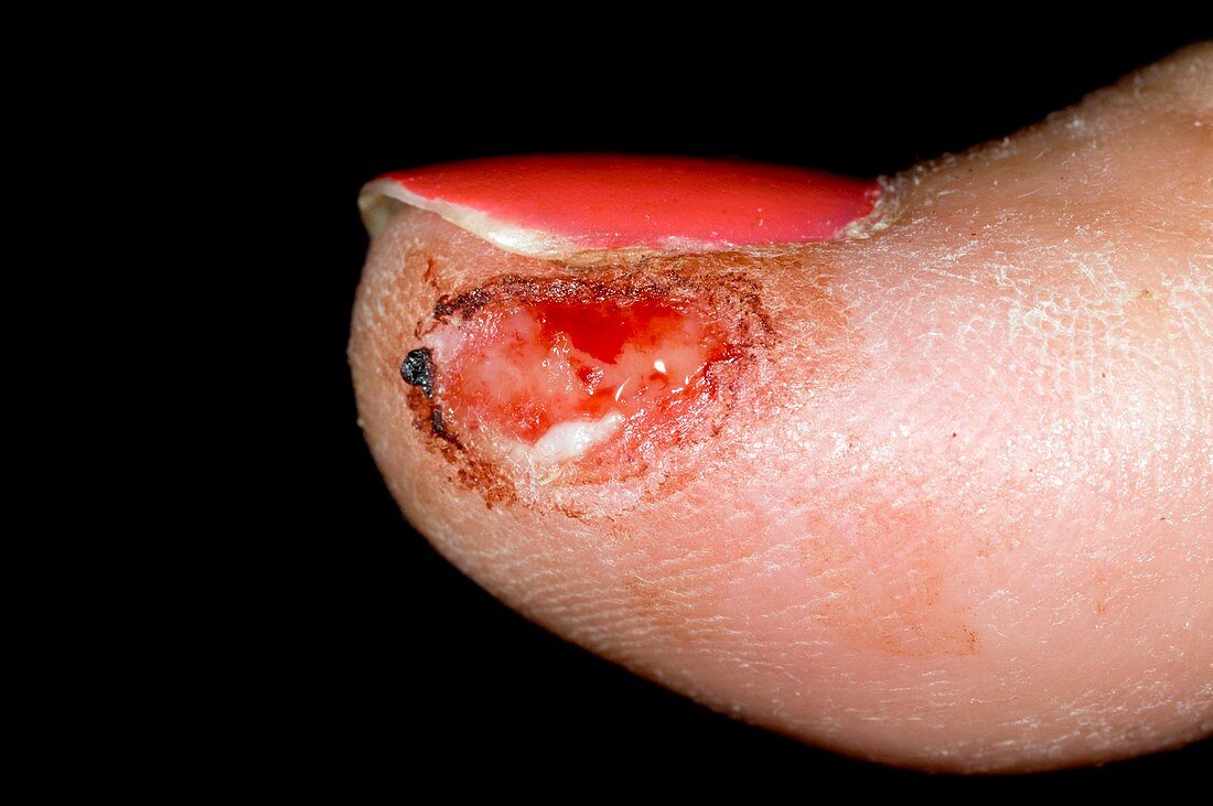 Sliced tip of the thumb