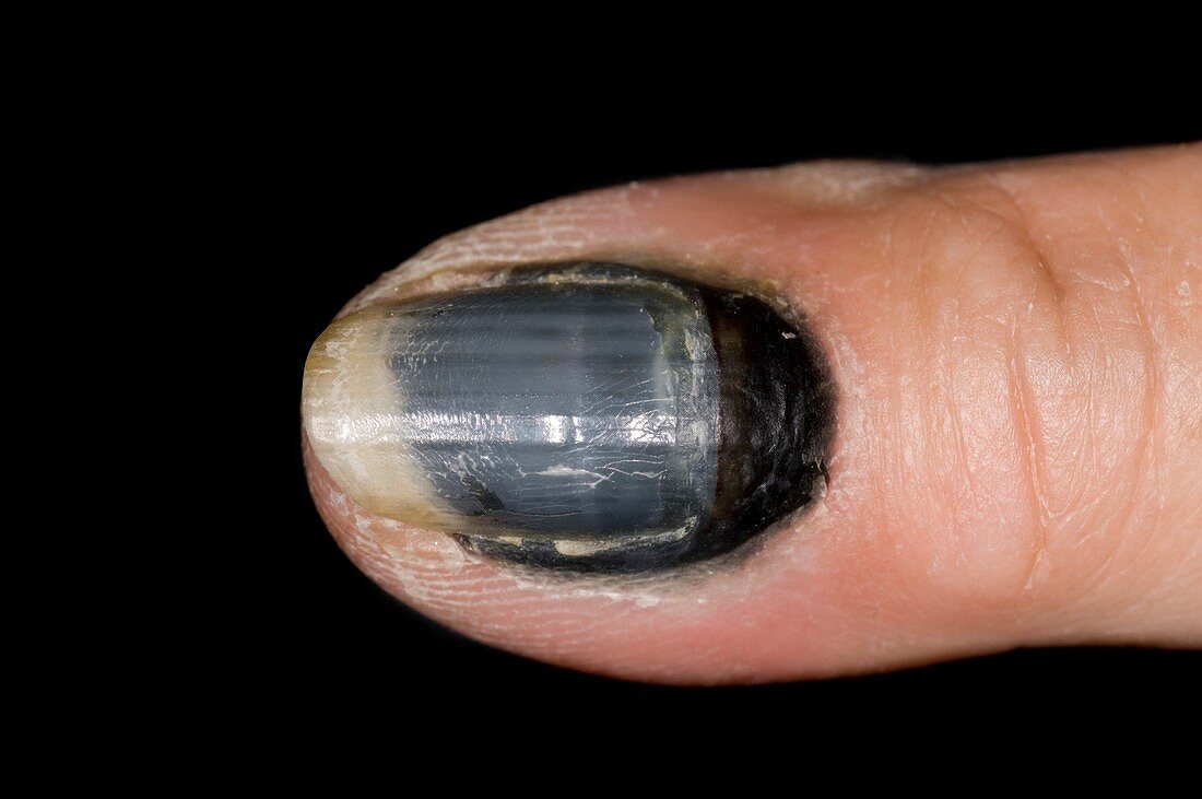 Bruising under the fingernail
