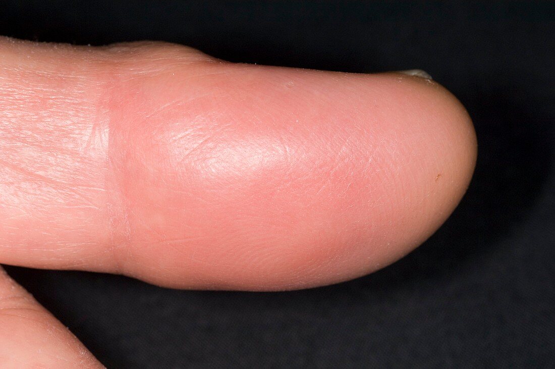 Abscess in pulp space of the finger