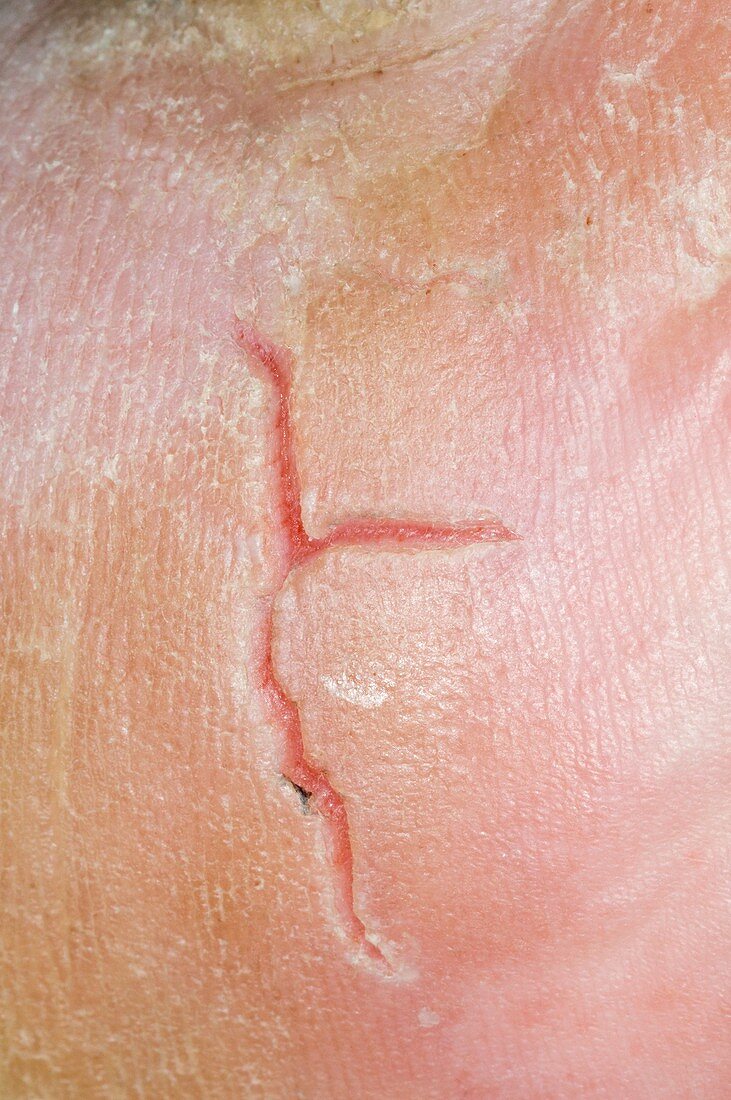 Skin fissure from eczema on the heel
