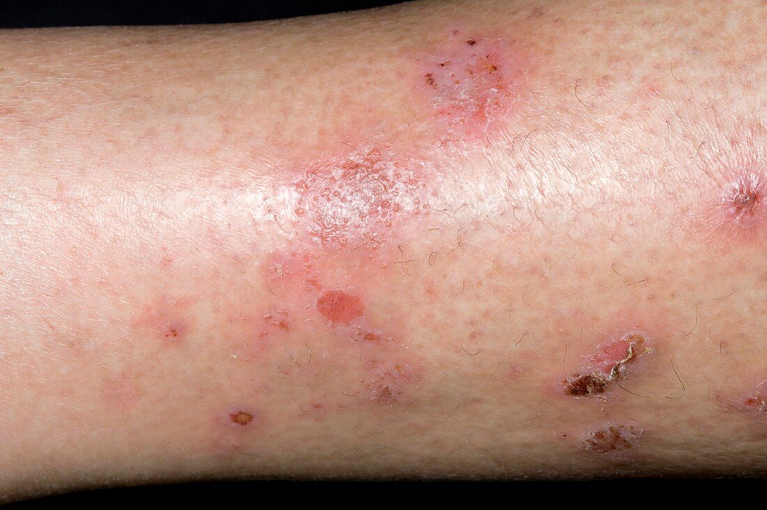 Spongiotic dermatitis on the leg