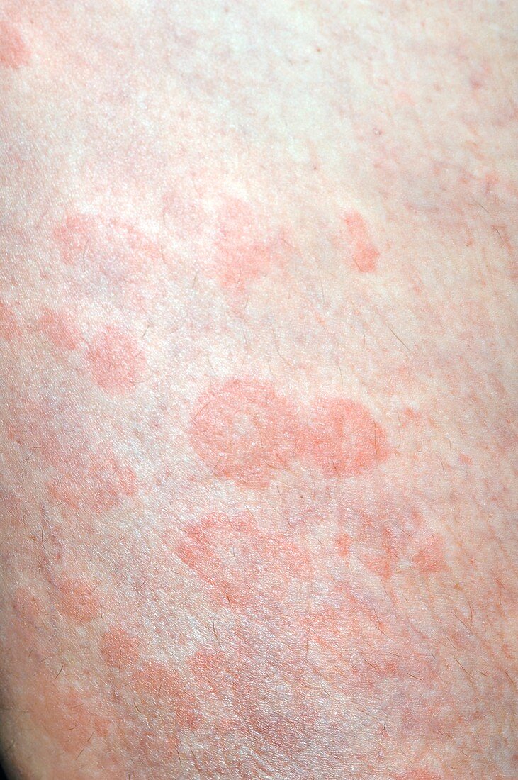Urticaria (hives) on the leg