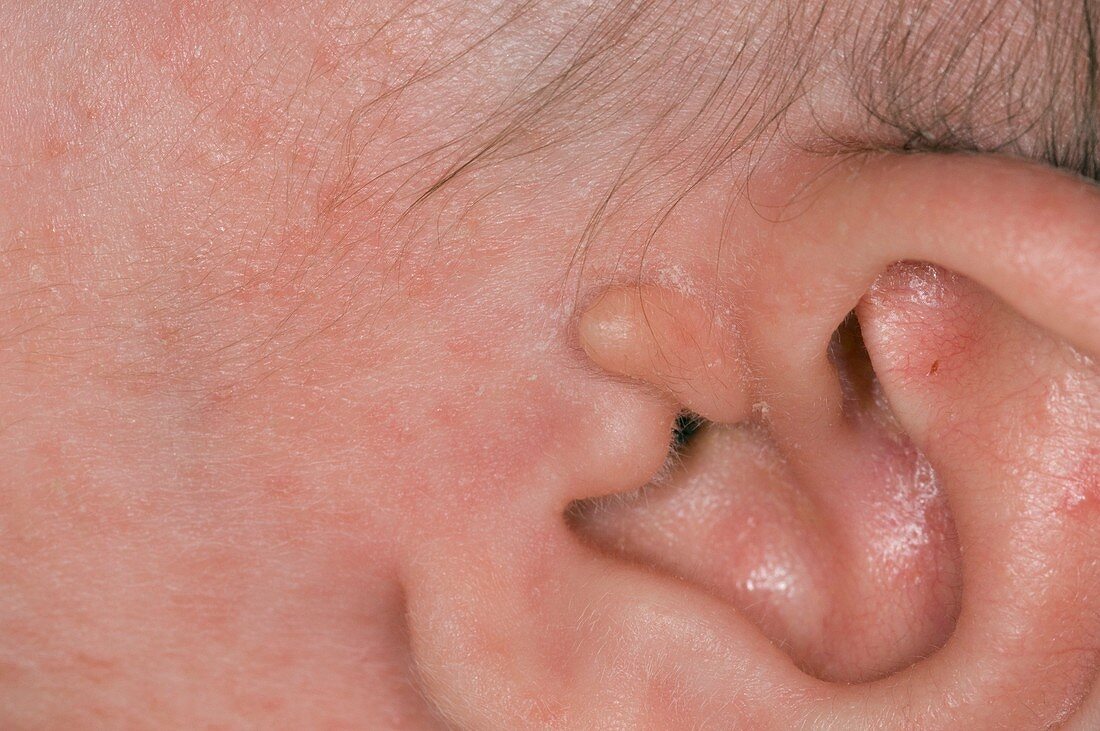 Accessory auricle ear deformity