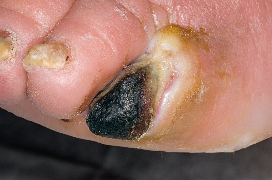 Gangrenous toe