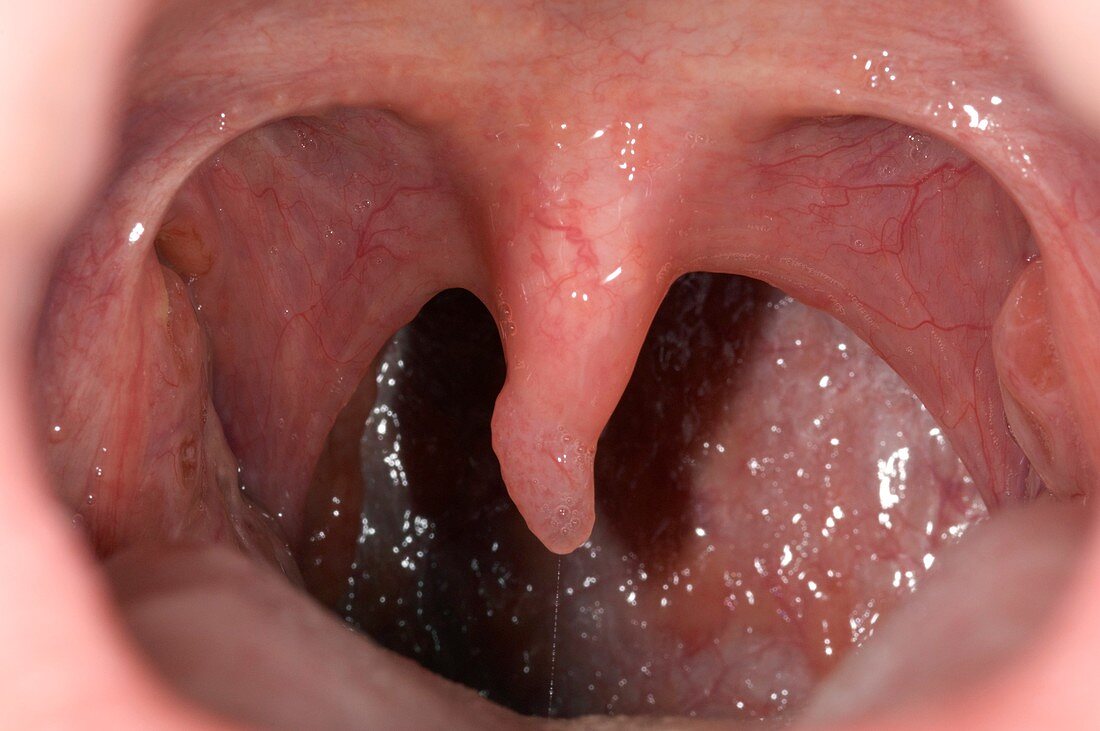 Polyp on the uvula