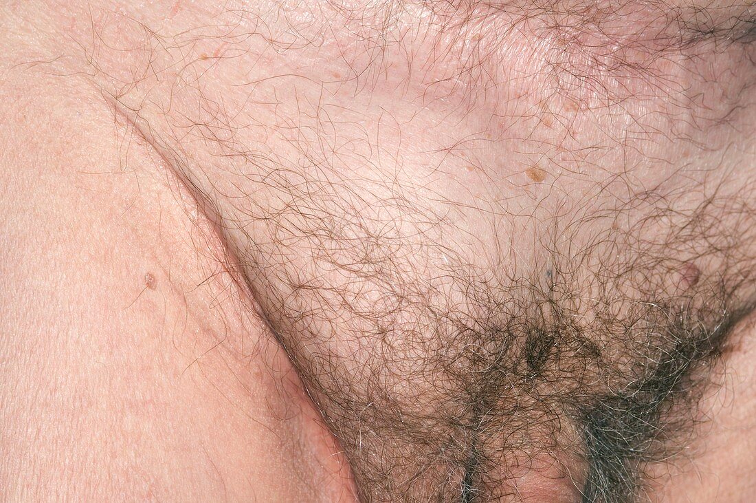 Inguinal hernia in a man