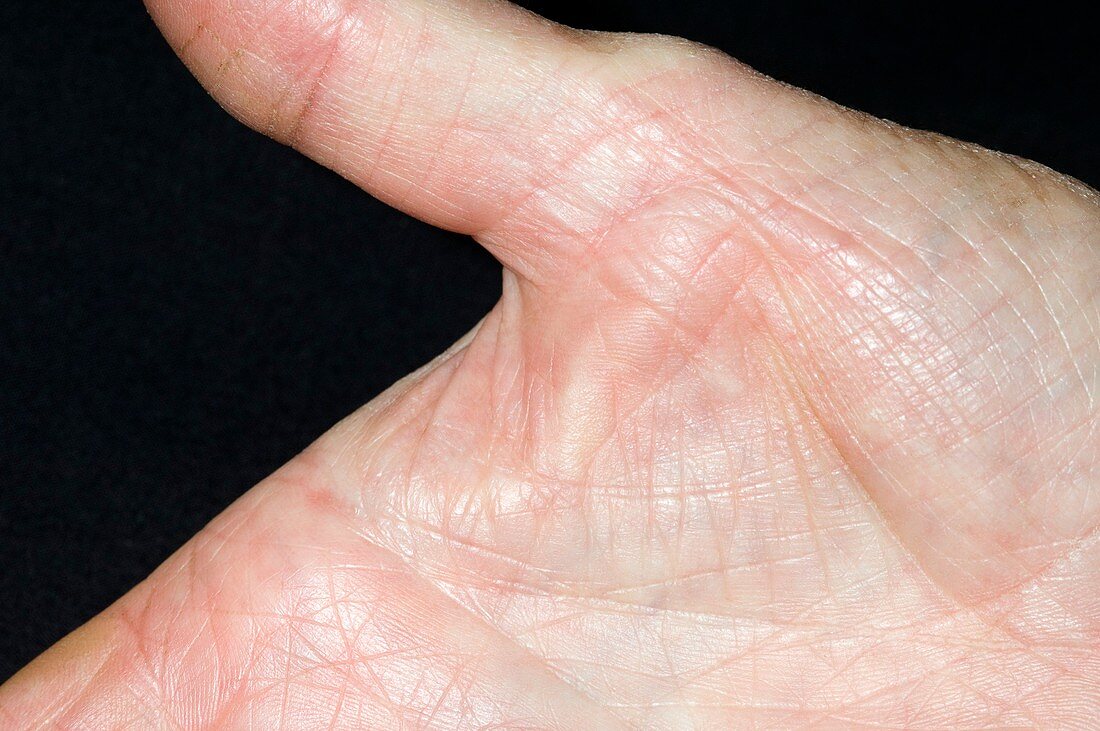 Dupuytren's contracture of the thumb