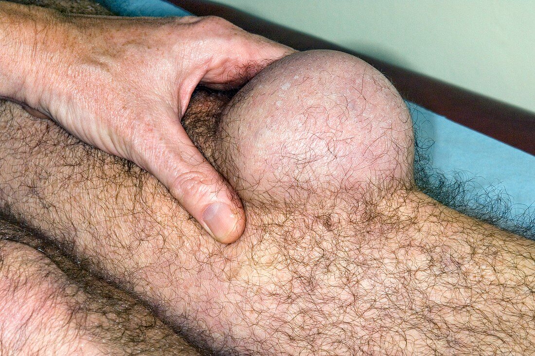 Pre-patellar bursitis in the knee