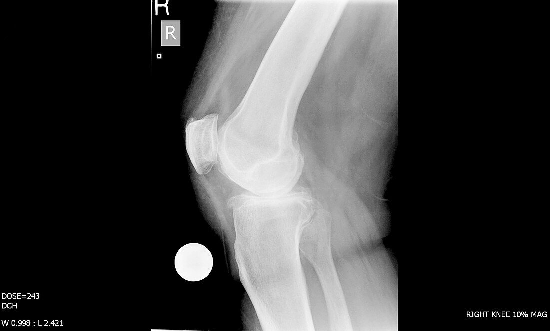 Knee before replacement surgery,X-ray