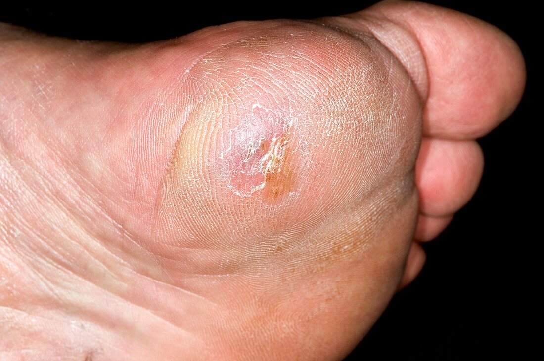 Ulcer in claw foot (pes cavus)
