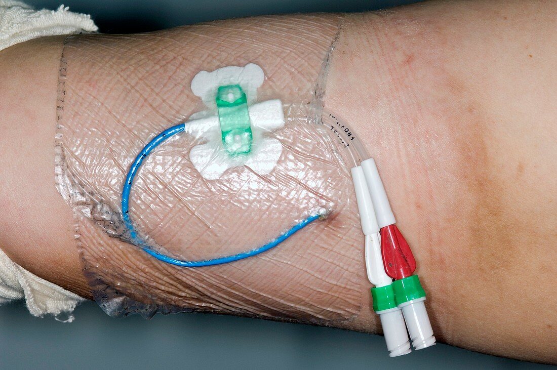PICC intravenous chemotherapy device
