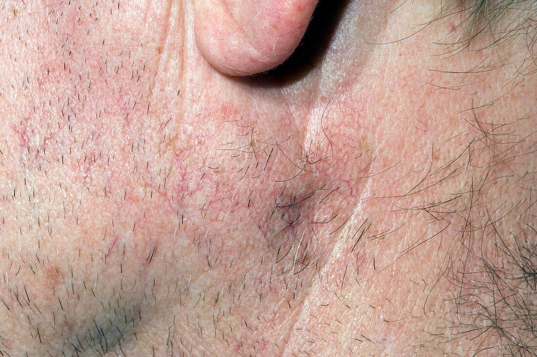Basal cell skin cancer spread to lymph