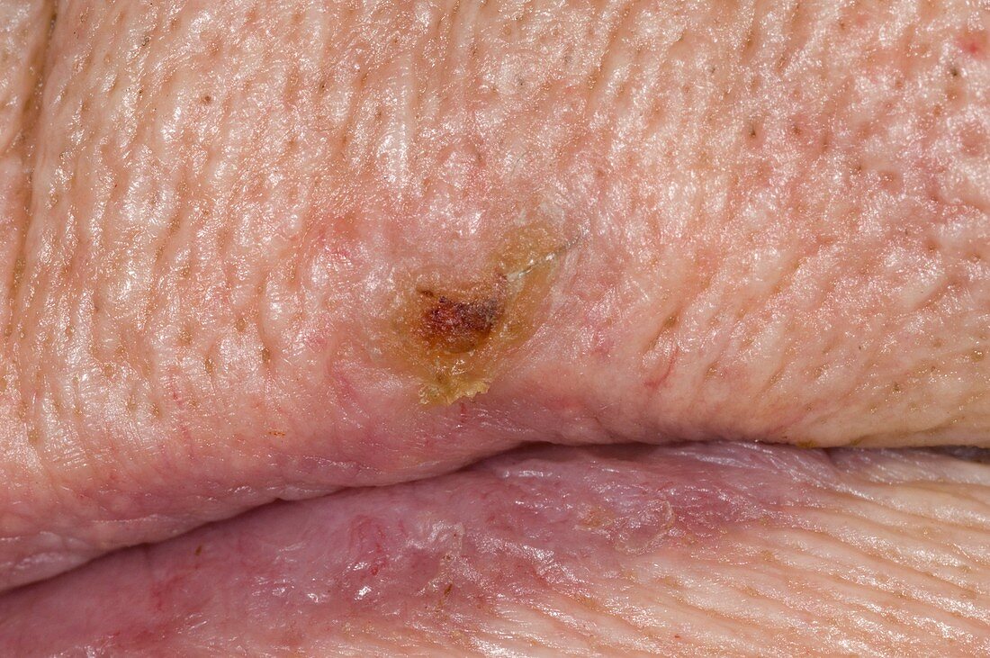 Basal cell skin cancer on the lip