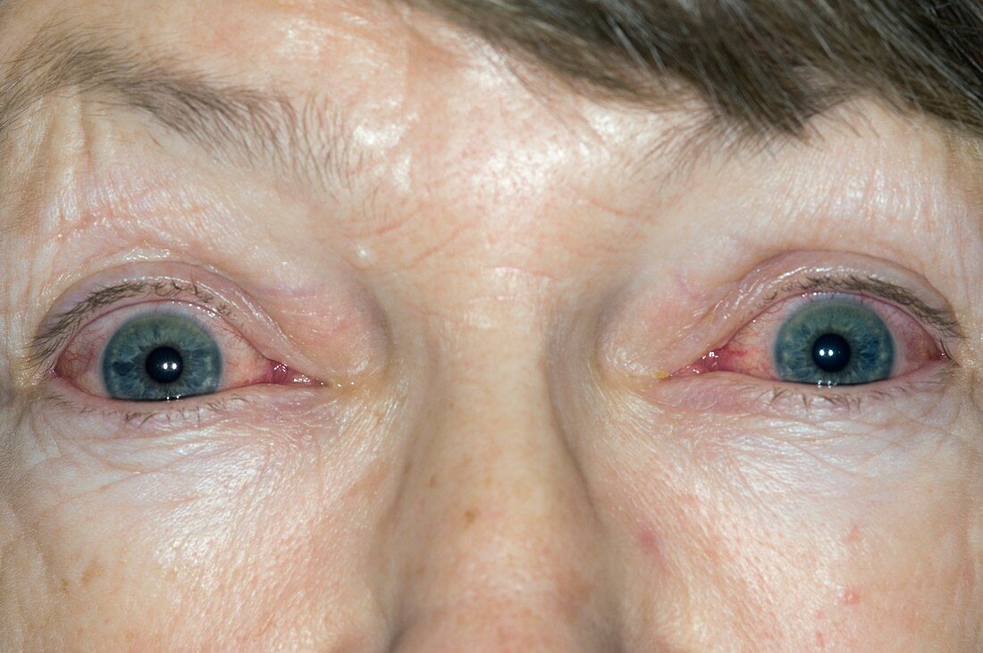 Red eyes from viral conjunctivitis