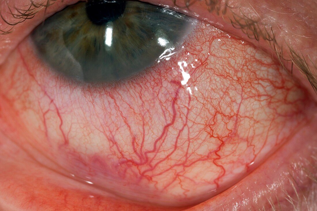 Iritis of eye in ankylosing spondylitis