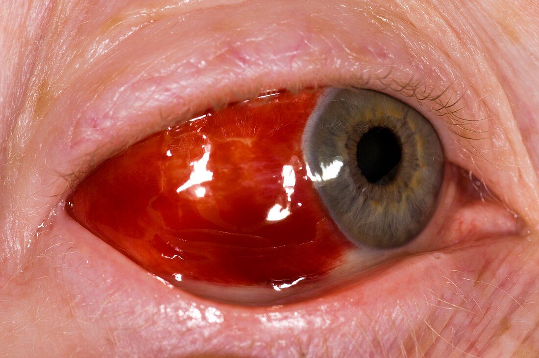 Bleeding (haemorrhage) in the eye
