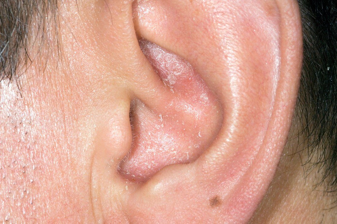 Psoriasis in the ear