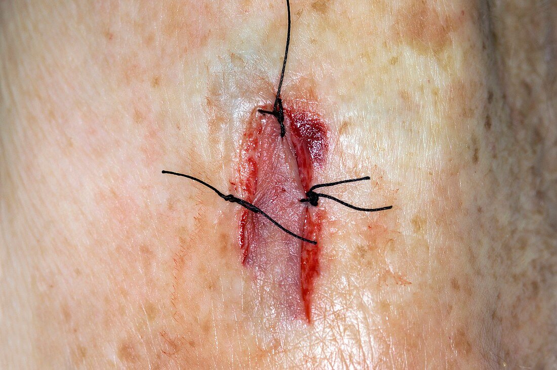 Sutured flap laceration on the arm